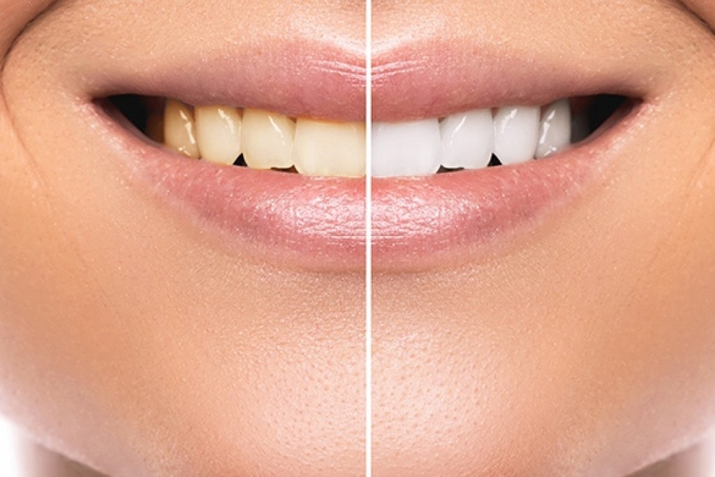 tratamientos-laser-faciales-image